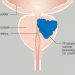 prostate cancer illustration