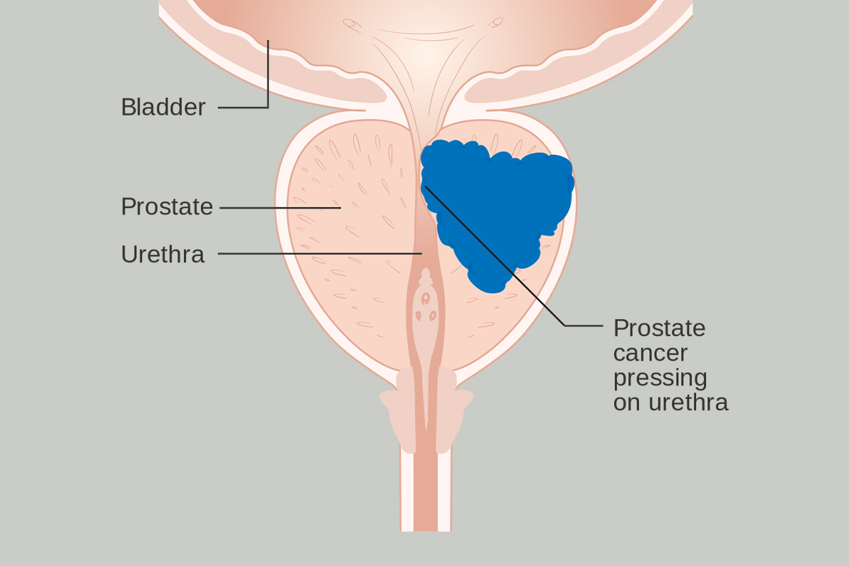 Herbal Remedies for Prostate Problems